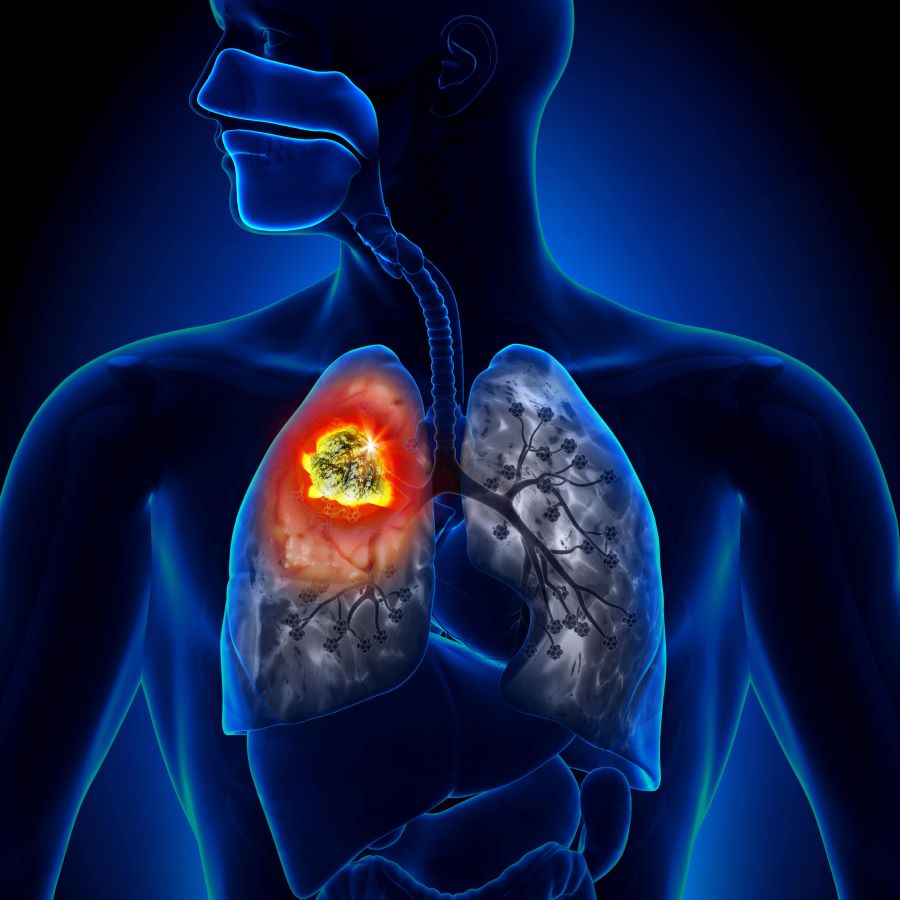 lung cancer treatment